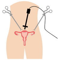 Laparoscopic Surgery (Keyhole Surgery)