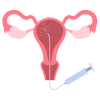 Intrauterine Insemination (IUI)